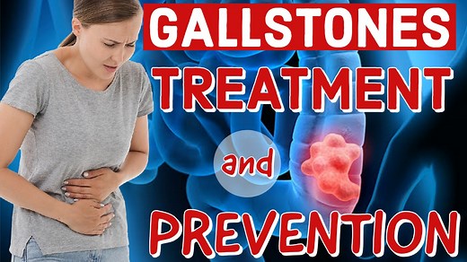 Gallstones Treatment And Prevention Tips By Dr. Willie Ong Internist and Cardiologist | Doc Willie Ong