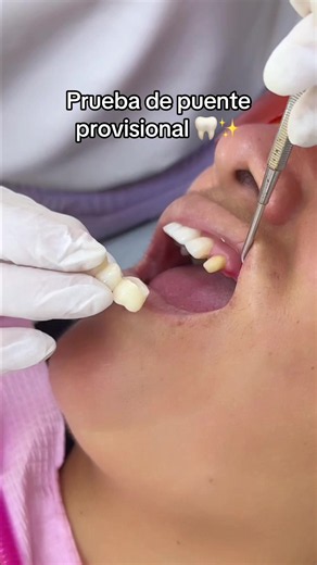 Proceso de prueba de puente provisional antes de la colocación de un puente de zirconia multilayer Cada etapa es importante para conseguir una sonrisa funcional, natural y duradera #diseñodesonrisa #protesisdental #odontologiaestetica #dientesblancos #zirconia