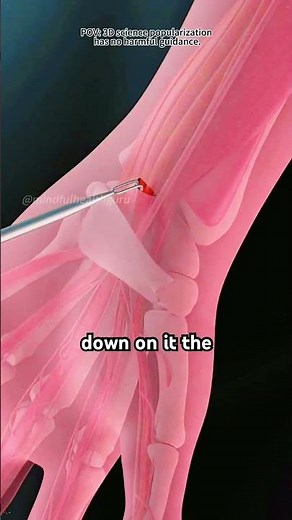 Carpal Tunnel Release Surgery (3D Animation)