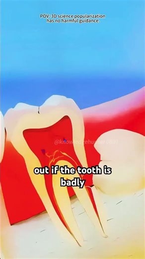 Removing a bad tooth | Tooth extraction procedure 3d animation