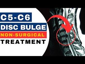 C5-C6 Disc Bulge Treatment Without Surgery: Over 90% Success Rate! | Dr. John Zielonka