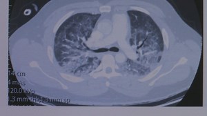 Health experts concerned vaping could cause widespread health issues