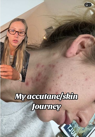 Alix Earle's Accutane Skincare Journey & Routine