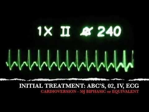 ACLS ECG Recognition SVT- Classes Sacramento