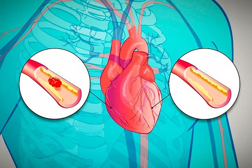 Enfermedades del corazón, primera causa de muerte - Gaceta UNAM