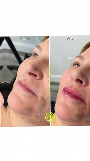Lip filler before and after