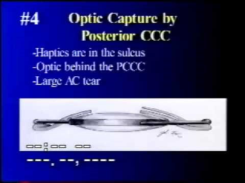 Six Variations of Optic Capture