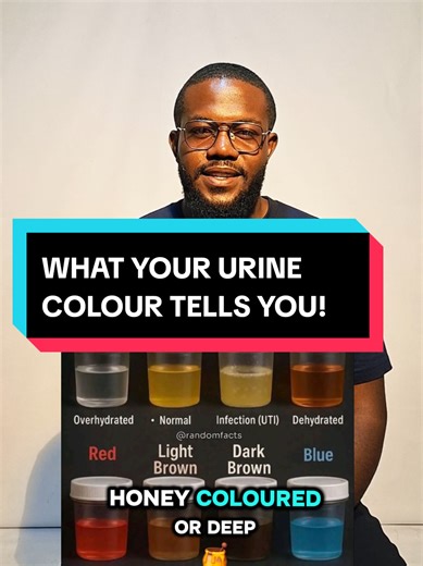 Colourless urine is not the most healthy! What urine color can tell you Clear / very pale Very well hydrated Sometimes over-hydrated Usually normal Pale yellow (straw-colored) ✅ Ideal / normal Good hydration Kidneys doing their job well Dark yellow Mild dehydration Drink more fluids Amber / honey-colored Moderate dehydration Concentrated urine Orange Dehydration Can be due to: Certain drugs (e.g. rifampicin, phenazopyridine) Liver or bile duct disease (↑ bilirubin) Red / pink Blood in urine (hem