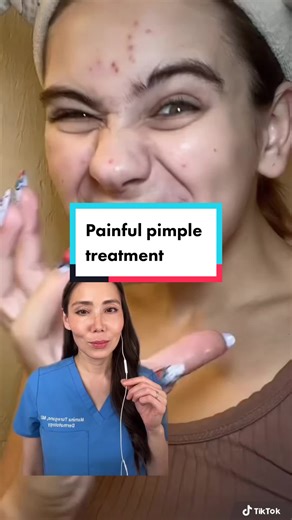 Effective Painful Pimple Treatment Tips