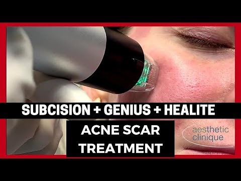 Rolling Acne Scars treated with Cannula Subcision, NEW Genius, and Healite