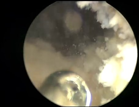 Holmium Laser Ablation of Prostate (HoLAP)