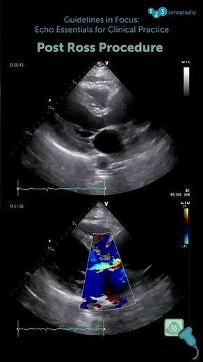Aortic root dilatation 👀