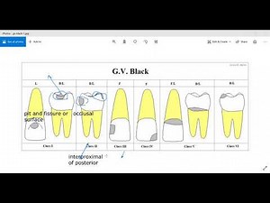 classification of dental caries (GV Black)