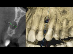 An Asymptomatic Odontogenic (Tooth-Related) Cyst: Surgical and Endodontic Management