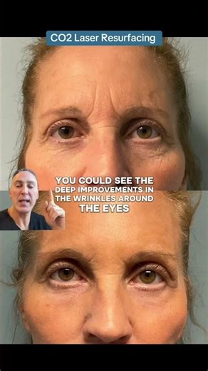 CO2 Laser Resurfacing 