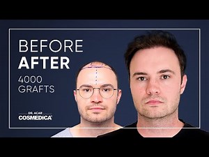 Hair Transplant in Turkey | Results | Dr. Acar | Cosmedica Clinic