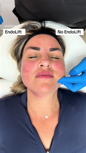 EndoLift vs No EndoLift #endolift #endolaserlift #endolaser #miami #coralgables