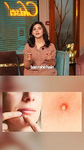 119K views · 1.2K reactions | Pustules aren’t ‘normal’ breakouts. Here’s what they actually mean. • • • • • • #chisel #hifufacial #hydrafacials #qswitch #skincare #skinaesthetics #hifu #mifu #rfmicroneedling #hydrafacial #naddrips (Best Skin Aesthetics Clinic in Lahore, Skin Care, pustules, Fotona 4d,Hydra Facial, Hifu Fotona, Q Switch Laser) | Chisel | Facebook