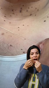 Isso é Acrocordons. Podendo ser Alteração insulínica. Nem tudo pode remover na linha, procure um profissional! | Patrícia Elias - Estética & Saúde