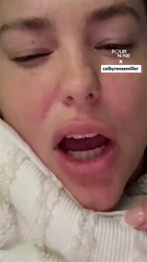 Pulling my facelift thread out my lip #shortsfeed #lip #shorts #thread # facelift