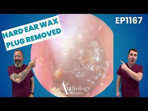Compacted Ear Wax Block Removed! So Satisfying! - EP1167