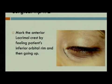 AIOC2018 - IC029 - DACRYOCYSTORHINOSTOMY (DCR) PATHSHALA