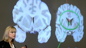 What is CTE? NFL shooter's medical examination findings explained