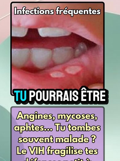 VIH : Symptômes invisibles et conseils santé