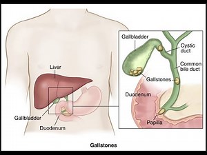 Choledocholithiasis: Common Bile Duct Stones: How to Treat them?