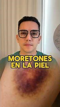 ¿Te salen moretones en la piel?Estas podrían ser las causas #medicina #dermatologia #consejosdesalud