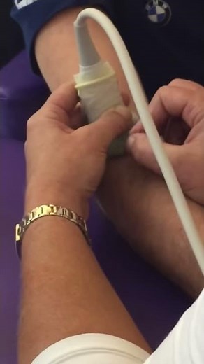 Ultrasound guided dry needling of the supinator muscle