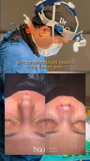 Behind the Scenes: Why Use Local Anesthesia During Rhinoplasty Surgery?