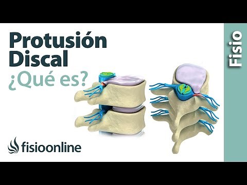 Protrusión discal - ¿Qué es?