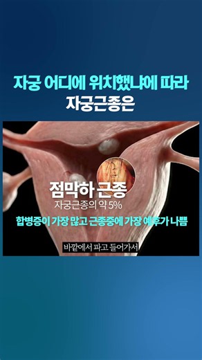 자궁근종이 생긴 위치에 따라 증상도 천차만별 #자궁근종 #자궁선근증