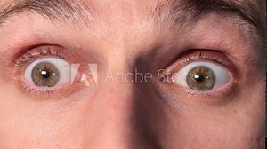 Tired red man's eyes. Dry eye syndrome. Computer work bad consequences. Close up view.