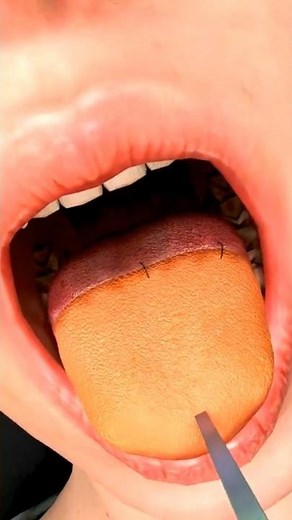 Tongue Cancer Surgery Reconstruction Story