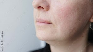 virus herpes simplex on lip skin, sore vesicles cause discomfort of herpes bumps on woman face. smiling woman face with herpes on lip. itching burning feeling symptoms upper lip viral disease herpes