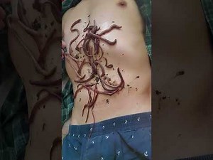 36 worms on my belly!