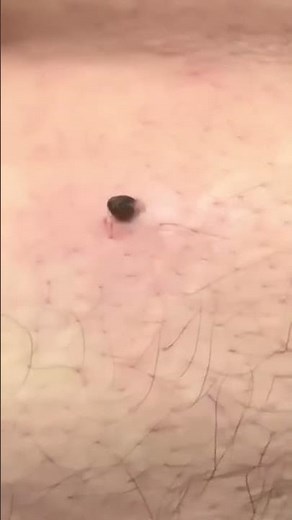 Nice Dilated Pore of Winer #shorts #dermatology