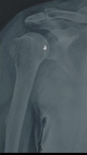 Lytic lesion in a 60 year old #MSK#oncology #orthopedics #mskradiology #anatomy #science #athletes