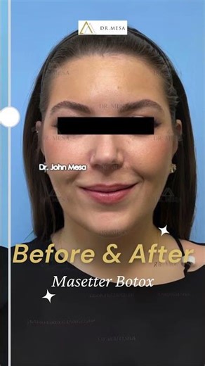 Masseter Botox Results #beforeandafter #plasticsurgery #nyc #botox