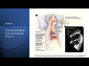 Transesophageal Echocardiogram (TEE): Indications and Contraindications