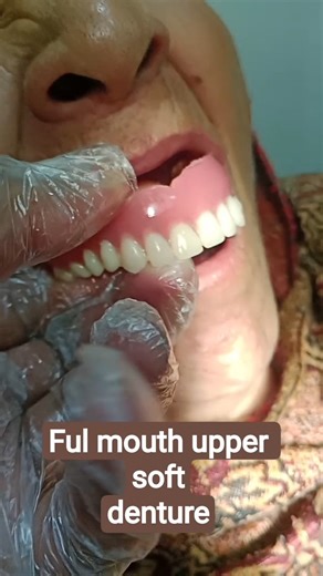 Ful mouth upper soft Denture #denture #shortvideo #dentist #shortsfeed #orthodontist #dental