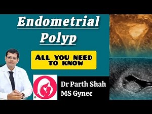 Endometrial Polyps Explained: Everything You Need to Know#UterineHealth #MedicalEducation#HealthTips