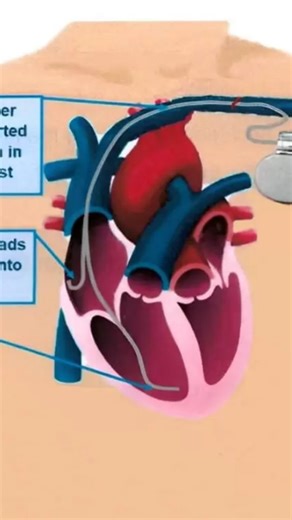 ⚕️Dr. stranger 👩‍⚕️ on Instagram: "👉What is pacemaker? ✨A pacemaker is a small electronic device that helps control abnormal heartbeats. It is usually implanted under the skin near the chest and sends electrical signals to the heart to keep it beating at a normal and steady rate. Pacemakers are commonly used when the heart beats too slowly or irregularly. . . #reelsinstagram #viralreels #instatrending #explorepage #instareelsindia❤️"