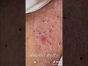 Pimple Popping TikTok Compilation Part 1 - Best/Satisfaying Blachead Removal Video Compilation
