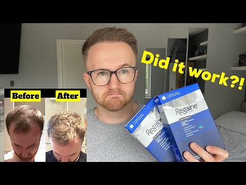 How to apply Regaine - hair loss talk for men