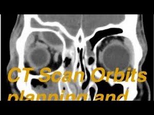 CT scan Orbit planning and procedure‪@discoveryzsm7667‬