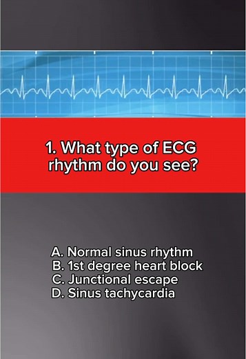 ECG/EKG Quiz: Test Your Medical Knowledge!