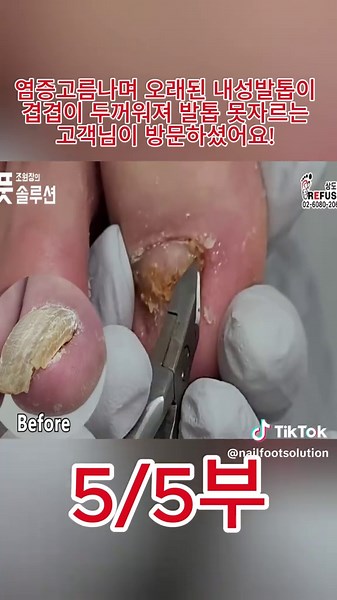내성발톱 교정: 두꺼워진 발톱, 염증 치료